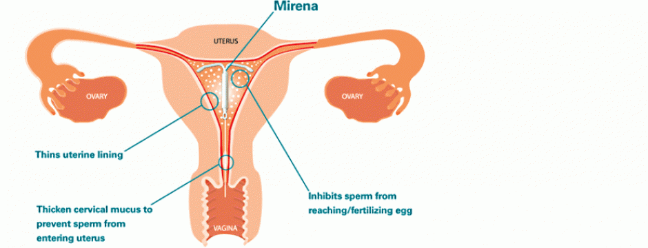 bleeding-after-mirena-removal-what-you-should-know-hirharang