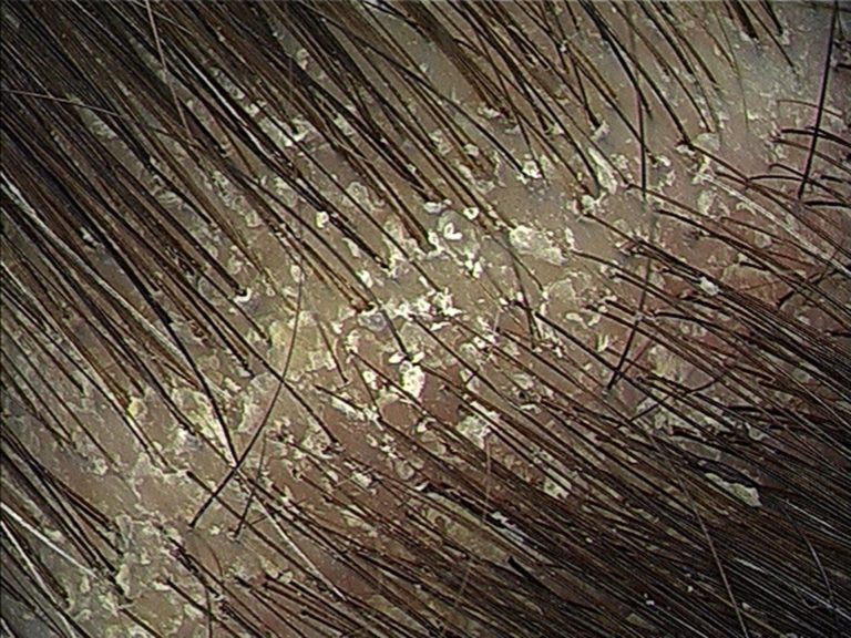 Major symptoms of dandruff formation Hirharang